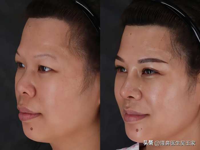 40岁到北京做了鼻子，30天后：自己没看出变化，身边人都说好看了