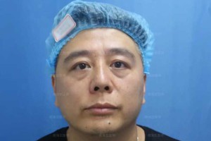 46岁外地大哥，来深圳做不开刀去眼袋，术后10天简直太帅了