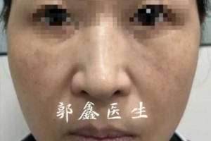 46岁专门到北京做面部提升，即刻效果惊到我了，坦白几点真实感受