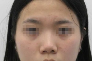 30岁姑娘天生鼻子塌，来北京做了鼻整形，术后仿佛“换脸”了