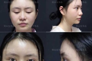 27岁姑娘来做驼峰鼻修复 双眼皮修复，术后1-6个月全纪录，很惊艳