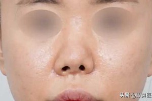 32岁广东女士独自赴京整容，隆鼻失败修复，术后效果难以置信!